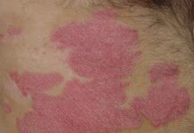 SALUTEQUITA’ Cronicità, Associazioni chiedono l’inclusione di oncoematologia e psoriasi nel Piano Nazionale