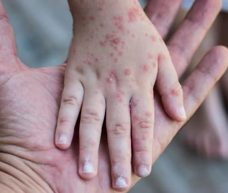 Morbillo. Iss: “In Italia 485 casi da inizio anno, 1 su 3 con complicanze”