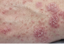Quattordici casi di scabbia alla Rsa Villa Solaria di Sesto Fiorentino
